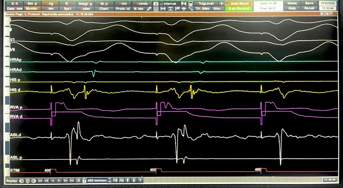 VA block in AP during RFA.