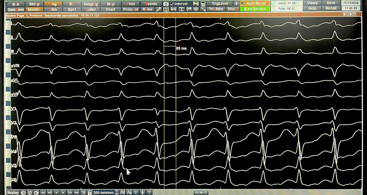 For ECG lovers.

ORT with big retrograde P waves in inferior leads.
These are  the tallest retrograde P waves in ORT I have ever seen in inferior leads.
