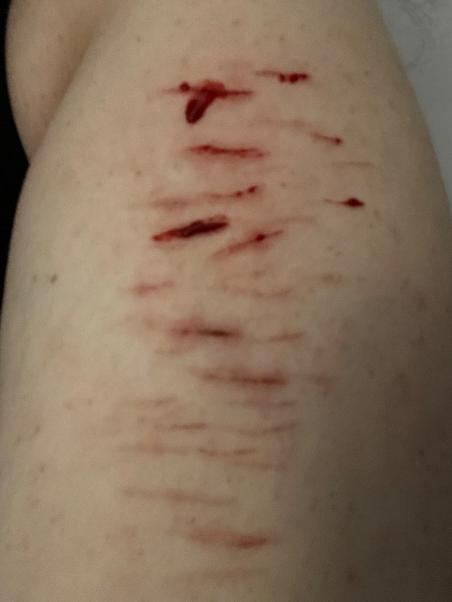 WeirdcoreEnthu1's tweet photo. fresh vs healed ( 8-10 hrs l8r )

ok baaiiiii https://t.co/9vZ2Y0IJRu