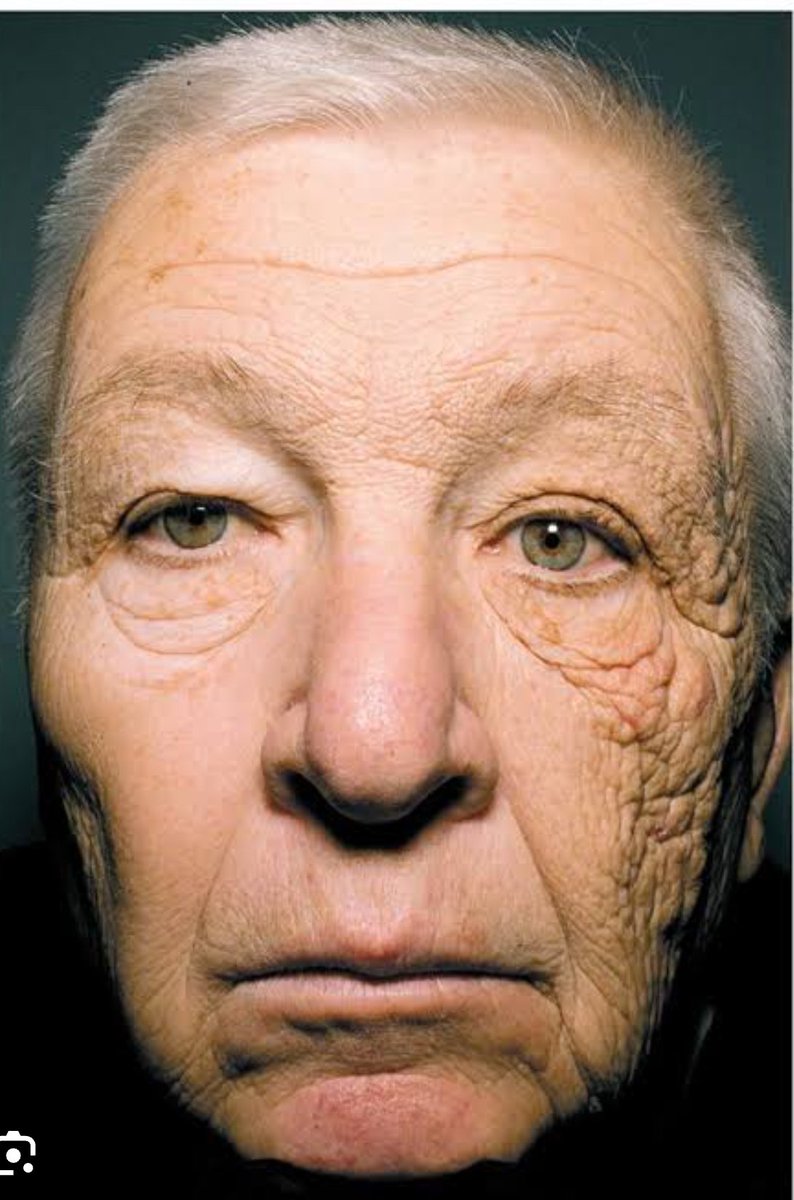 doakozmetik's tweet photo. Toplaşın size kozmetik endüstrisinin algılarınızla nasıl oynadığını ve nasıl sözde bilimcilik yaptığını anlatacağım.

Evvela şu konuda bilimsel olarak anlaşalım. Güneş ışınları zararlıdır ve zenith açısına göre uv indeksi 2 ve üzerindeyse saat 10-16 arası güneşe maruz kalmamalısınız.

Güneşe maruz kalacaksanız da evvela fiziksel korunmaya sonra en son çare olarak güneş kremlerine güvenmelisiniz.

Şimdi aşağıda iki meşhur foto var birisi, şöför bir amcamız işi gereği ışığa maruz kalmış cildinin bir bölümü ve maruz kalmayan diğer bölümü maşallah turp gibi. Demek ki neymiş güneşe maruz kalmayacakmışız.

Evet doğru.

Diğer fotoğrafta çiftlikte çalışan bir teyzemiz kısa kollu tişört giymiş, tişört olan taraf akça pakça iken açıkta kalan kısımlar oldukça hasar görmüş.

Demek ki neymiş yazın uzun kollu tişört giyersek kolumuz bacağımız yanmazmış. Yani kumaş yeri geldiğinde iyi bir koruyucuymuş.

Şimdi gelelim ana konumuza son 4 senedir evde güneş kremi kullanın, akşam bile güneş kremi kullanın diye bir şey pompalanıyor. Bir çok insanı ikna ettiler. Üstelik bu görselleri servis ederek. 

4 sene önce ne oldu acaba, bingo corona virüs, peki bizler küresel olarak ne yaptık ece kapandık. Sonra ne oldu evde bile güneşten korunmamız gerektiğini öğrendik.

Bir Allahın kulu çıkıp da, ince bir tişörtün koruduğu kol ortada koca duvarlar arasında neden güneş kremi sürelim demedi.

Ya da şöför amcamızın güneş gören yüzü tamam. Ama diğer cephede camdan gelen ışık zarar vermemiş. Demek ki araba içinde camlar kapalıyken ışık bizi o kadar etkilemez demedi.

Bütün insanlığı reklam ve algıyla koyun gibi güden bir endüstriye karşı çıkıyoruz. Herkesin servis edilen bilgiyi kabul ettiği ortamda gerçekleri  araştırmaya çabalıyoruz. Sadece kendi kaynaklarımızla.

Bakın bu kozmetik kişisel bakım konusunda bildiğinizi sandığınız çoğu şey yalan dolan. Üstelik öyle hamasi de konuşmuyoruz. Test ediyor araştırıyoruz.