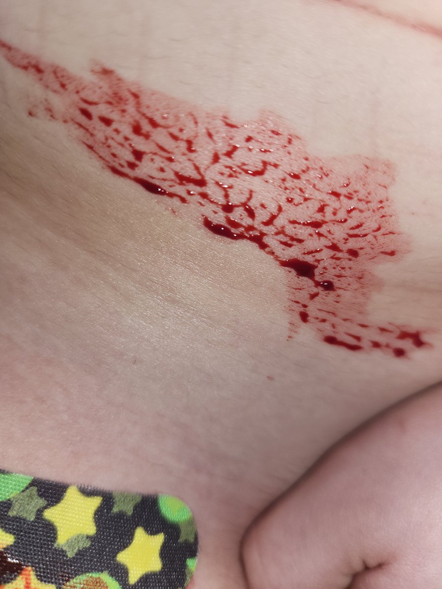pringless_cann's tweet photo. ITS BEEN SO LONG WHY IS IT STILL BLEEDING. https://t.co/RDhiI7Okac