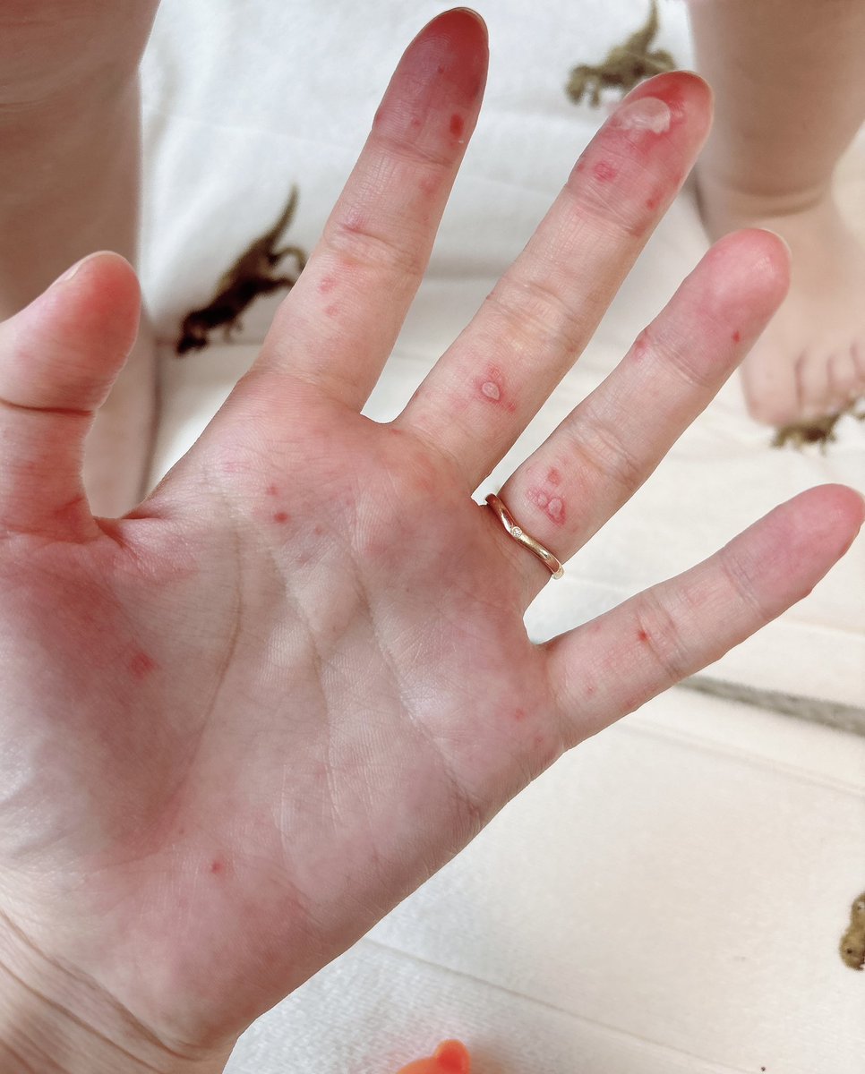 muchirin1226's tweet photo. 娘の手足口病が見事に私に移りまして。
水疱だらけになって、全てが痛い🤣
口の中は火事です🔥 https://t.co/YEDh7hxOd7