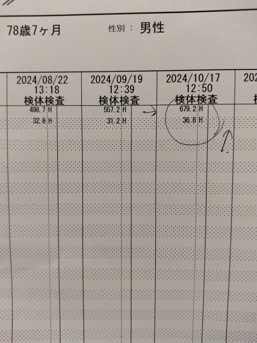 3ヶ月前よりポマリストに変更しましたが、フリーライトチェーンが増加しているため、来週から二重特異抗体の治療をスタートすることになりました。