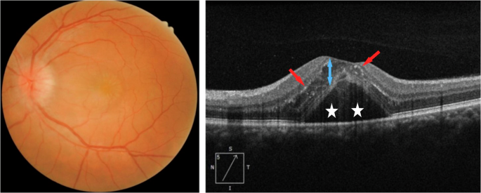 Ophthopedia Update: Neuroretinitis: a comprehensive review on aetiologies, clinical manifestations, and treatment options dlvr.it/TG9ZNV #Ophthalmology #Eye #Ophthotwitter