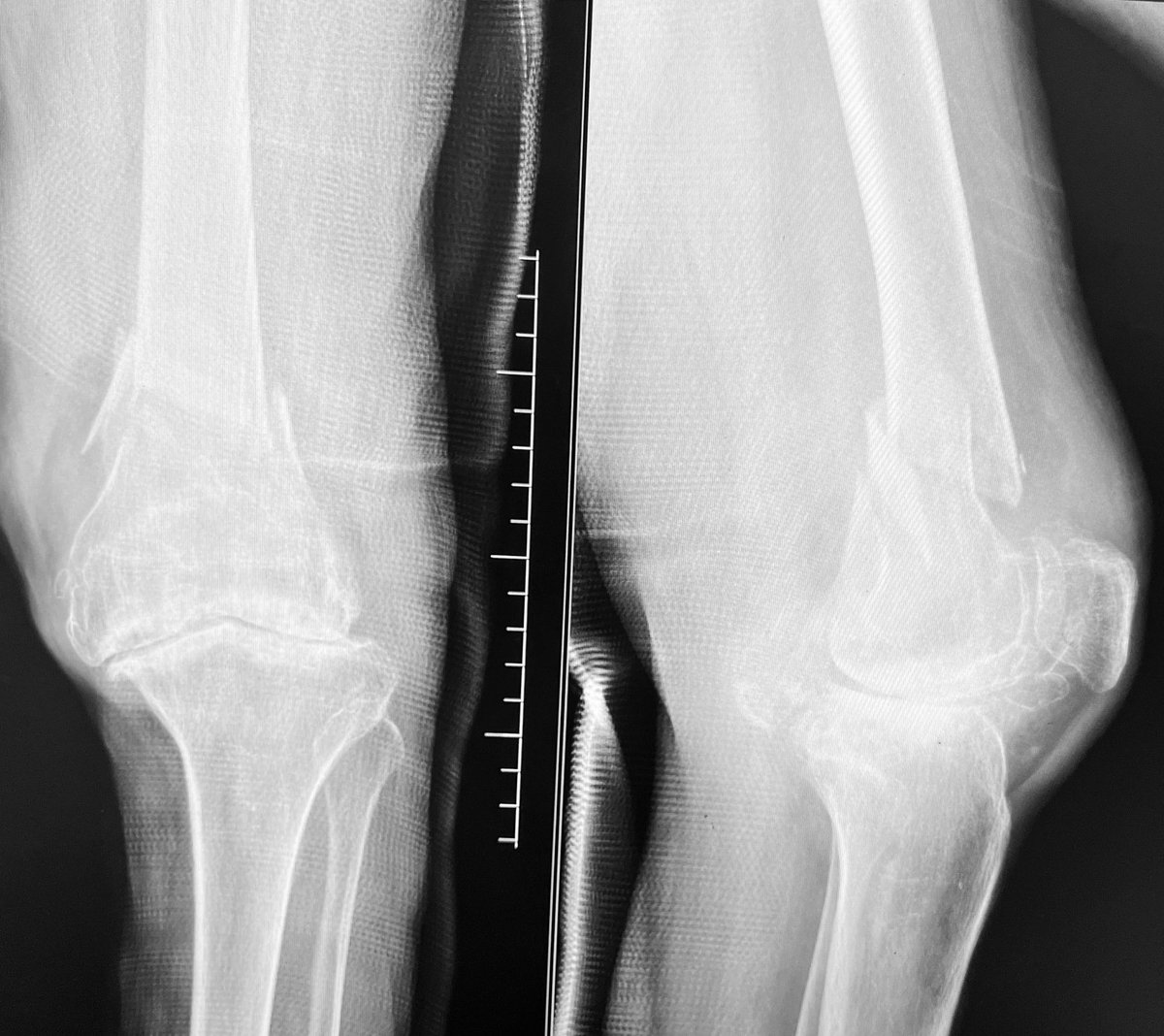 Bipin Theruvil FRCS (T&O),FRCS (Ed&Glasg),MS AIIMS tweet media