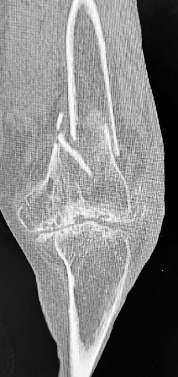 Bipin Theruvil FRCS (T&O),FRCS (Ed&Glasg),MS AIIMS tweet media