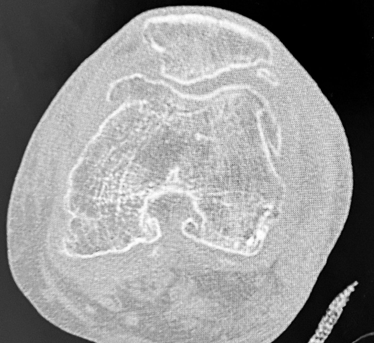 Bipin Theruvil FRCS (T&O),FRCS (Ed&Glasg),MS AIIMS tweet media