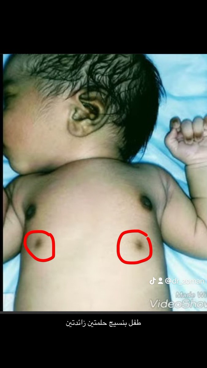 خط اللبن او خط الحليب ونسيج الثدي الزائد