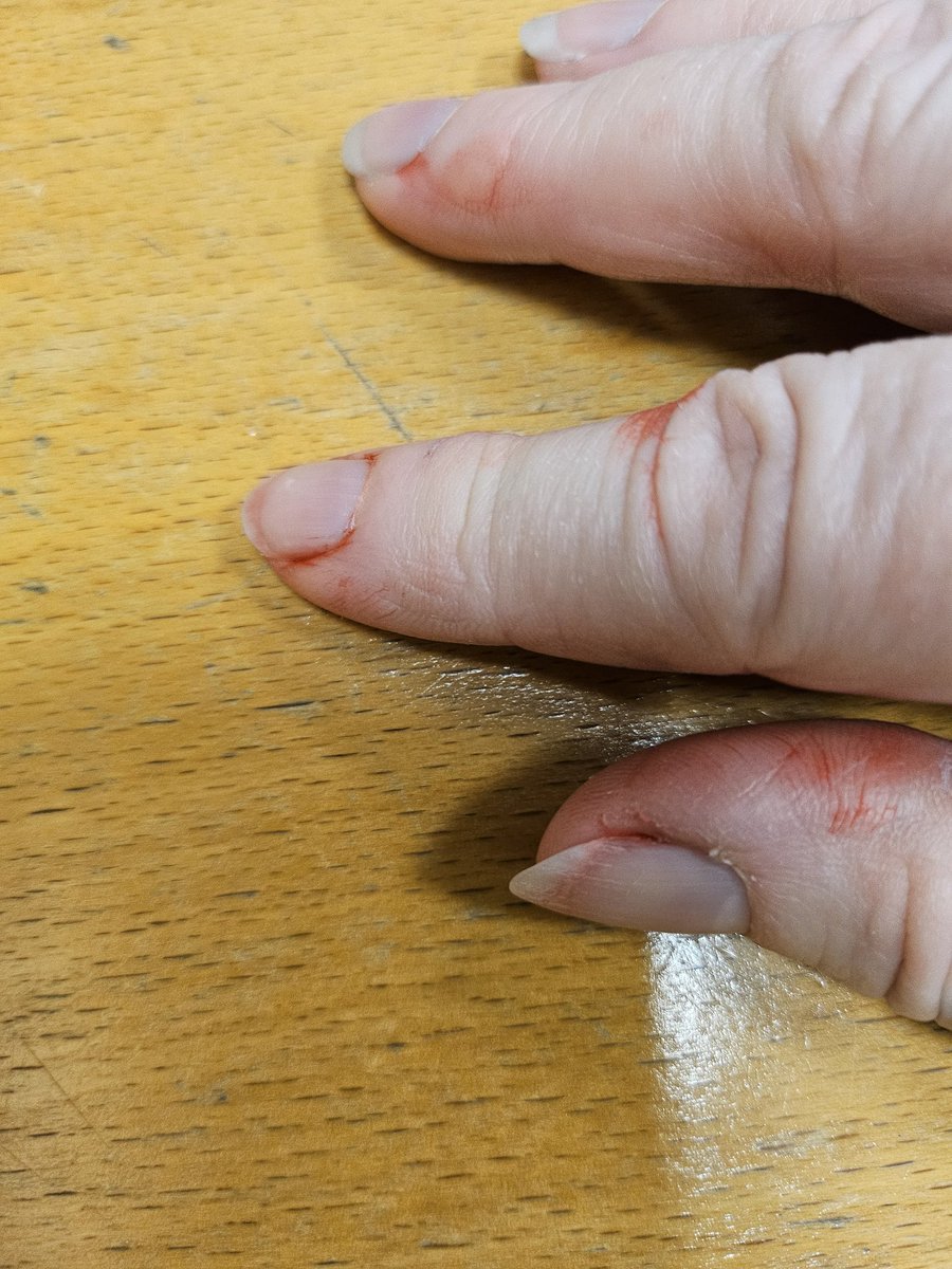 cazandal's tweet photo. Arms & hands all ready for our fab Cllnical Educators @CHFTCET to provide V&C training today, plus my lovely red fingers because I didnt put gloves on....again! 🤪 #SimTechsRock #MessyMe https://t.co/0yGHa8ztMw