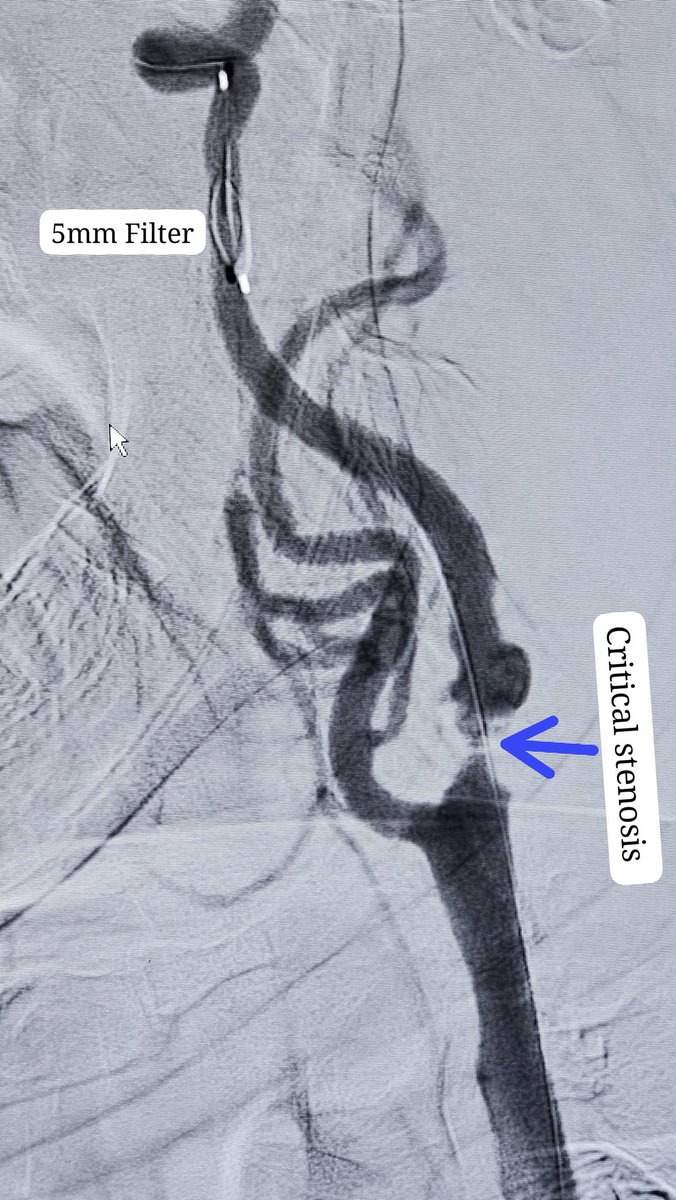SharathKumarGG7's tweet photo. Carotid Stenting with Distal Protection Device @ApolloKarnataka 
#Carotid #Stenting #Stroke #StrokePrevention #Embolic #Infarct  #CAS #Neurointervention #Neuroradiology #neurotwitter #Neurology #Neurosurgery https://t.co/Y9srPzjrzd
