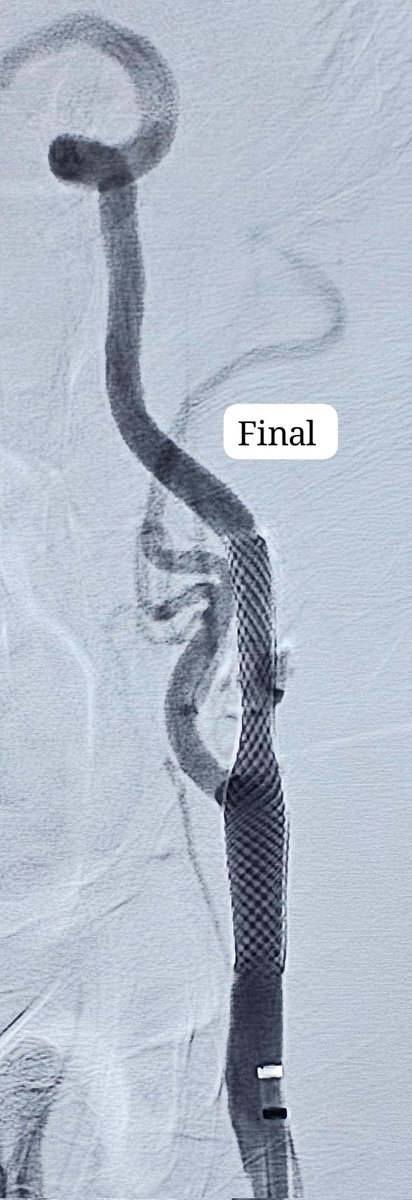 SharathKumarGG7's tweet photo. Carotid Stenting with Distal Protection Device @ApolloKarnataka 
#Carotid #Stenting #Stroke #StrokePrevention #Embolic #Infarct  #CAS #Neurointervention #Neuroradiology #neurotwitter #Neurology #Neurosurgery https://t.co/Y9srPzjrzd