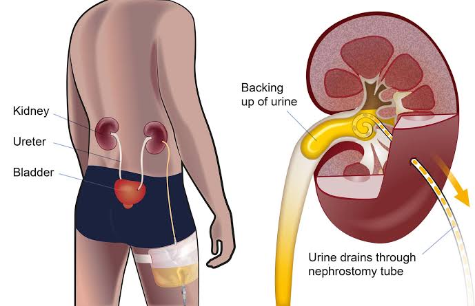 1ts_Mo's tweet photo. A bilateral nephrostomy involves placing tubes into both kidneys to drain urine directly, bypassing blockages in the urinary tract. This helps relieve pressure, prevent kidney damage, and allows healing. The procedure is guided by imaging, with tubes inserted through small incisions in the back.