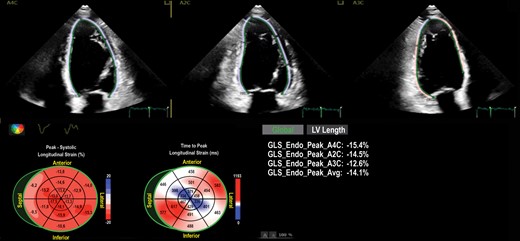 ESC_Journals's tweet photo. What are the cardiac manifestations of Behcet's disease? https://t.co/cYf2oGlS3y https://t.co/yyJQVe1IjM