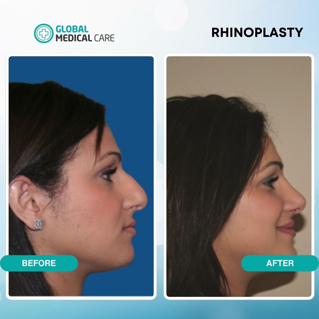 GlobalMedicalCH's tweet photo. Witness the stunning before-and-after results of our rhinoplasty procedure. From subtle refinements to dramatic enhancements.
Individual results and potential risks may vary. All images provided by licensed doctors. 
 https://t.co/SRbnwskbV1 https://t.co/wfBFt4JYi5