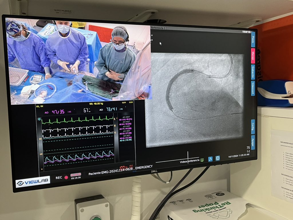Sergio Carrasco Castillo (@sergecarr1) on Twitter photo Fantastic case from <a href="/hospitaldelmar/">Hospital del Mar</a> <a href="/AnjaKsnes/">Anja Øksnes</a> <a href="/beavaquerizo/">Beatriz</a> plaque mod by Rotatripsy. Excellently finished with Synergy XD 4x38mm with excellent delivery in RCA. <a href="/ColletCarlos/">Carlos Collet MD PhD</a> at the controls of Avvigo+. @helenatmCARDIO <a href="/hcuberogallego/">Héctor Cubero Gallego</a> <a href="/xarmario/">Xavier Armario</a> <a href="/LeoDanduch/">Leo Danduch</a> Fantastic case from <a href="/hospitaldelmar/">Hospital del Mar</a> <a href="/AnjaKsnes/">Anja Øksnes</a> <a href="/beavaquerizo/">Beatriz</a> plaque mod by Rotatripsy. Excellently finished with Synergy XD 4x38mm with excellent delivery in RCA. <a href="/ColletCarlos/">Carlos Collet MD PhD</a> at the controls of Avvigo+. @helenatmCARDIO <a href="/hcuberogallego/">Héctor Cubero Gallego</a> <a href="/xarmario/">Xavier Armario</a> <a href="/LeoDanduch/">Leo Danduch</a>