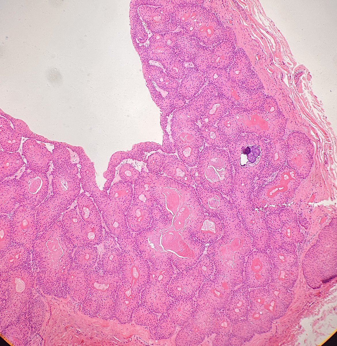 Path4People's tweet photo. I arise usually on the scalp, particularly elderly women
I am generally well circumscribed
I may look like my "younger sister", but have more squamous proliferation + may have some atypia + mites
Who am I?
#dermpath #pathx #path4people #pathagonia #pathtwitter #derm https://t.co/aOpozAVTFr