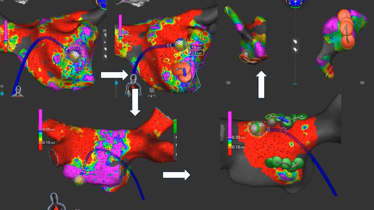 Konstantinos Letsas (@k_letsas) on Twitter photo Redo AF/AT ablation in a patient with HCM. PVs isolated at the index procedure. Anterior mitral line, posterior wall isolation and CTI flutter in 60 min with AFFERA system <a href="/Medtronic/">Medtronic</a>.
<a href="/SteliosDragasis/">Stelios</a> <a href="/Kariki_O/">Ourania Kariki</a> <a href="/athsaplaouras/">Athanasios Saplaouras</a> <a href="/ipetemil/">Panagiotis Mililis</a>
<a href="/PetrosSkalidis/">Petros Skalidis</a> <a href="/MEfraimidis/">Michail Efremidis</a>
#OCSC Redo AF/AT ablation in a patient with HCM. PVs isolated at the index procedure. Anterior mitral line, posterior wall isolation and CTI flutter in 60 min with AFFERA system <a href="/Medtronic/">Medtronic</a>.
<a href="/SteliosDragasis/">Stelios</a> <a href="/Kariki_O/">Ourania Kariki</a> <a href="/athsaplaouras/">Athanasios Saplaouras</a> <a href="/ipetemil/">Panagiotis Mililis</a>
<a href="/PetrosSkalidis/">Petros Skalidis</a> <a href="/MEfraimidis/">Michail Efremidis</a>
#OCSC