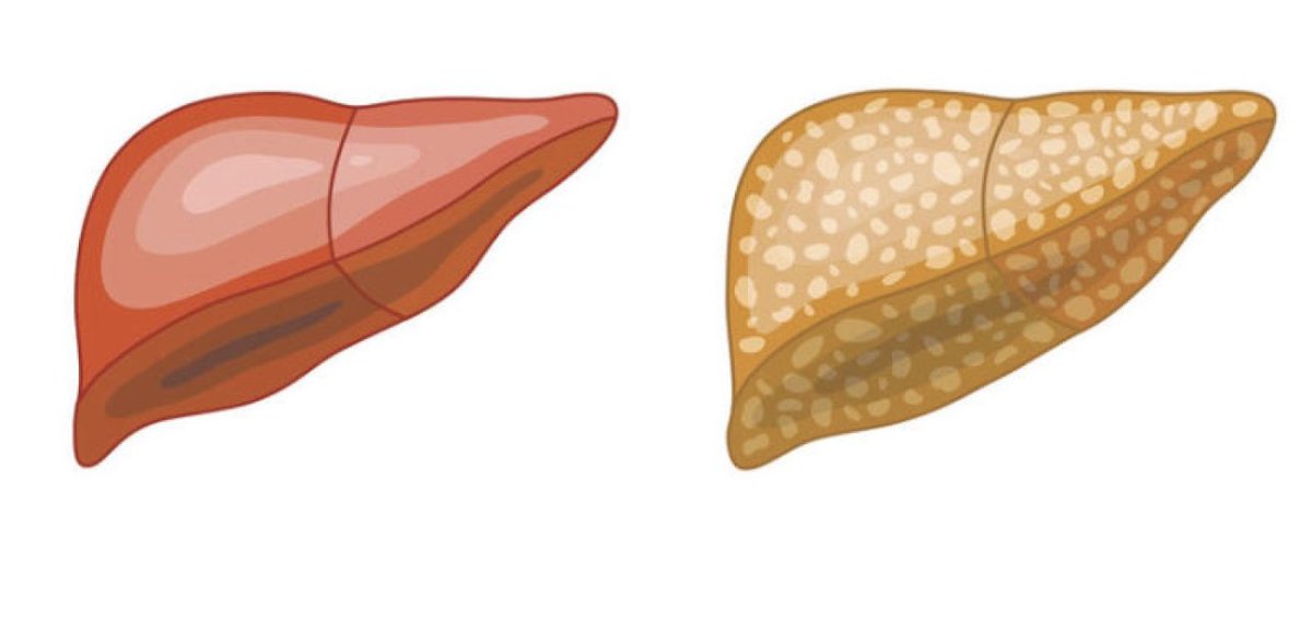 السمنة عند الأطفال ليست مجرد زيادة في الوزن، بل يمكن أن تؤدي إلى مشاكل صحية خطيرة مثل تراكم الدهون على الكبد، مما قد يتطور إلى تليف بمرور الوقت اذا لم يتم التحكم بالوزن