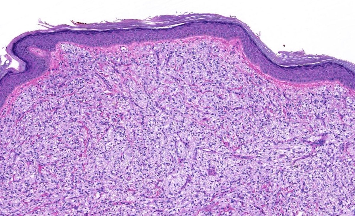JMGardnerMD's tweet photo. 67 yo F. 1.2 cm nodule anterior thigh. Clinical dx: lipoma. CD10+. 
Your diagnosis? (It's NOT RCC!) 
Digital slide: https://t.co/uhCX7oQtce
Answer &amp; video: https://t.co/x2Vs57OT8e
#pathology #pathologists #pathTwitter #dermpath #dermatology #dermtwitter #BSTpath https://t.co/TXW74WAzFP