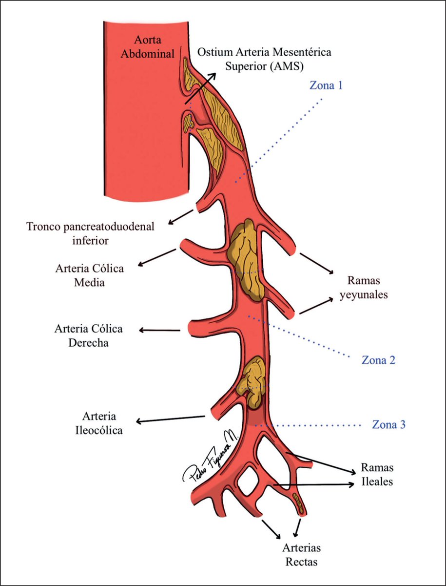 Dr. Mateo Avila (@drteoa) on Twitter photo Localización de la trombosis ateroesclerotica por zonas 👇🏻👇🏻 Localización de la trombosis ateroesclerotica por zonas 👇🏻👇🏻