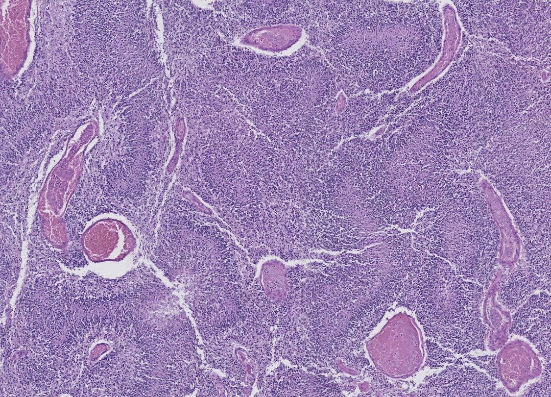 PeterKobalka's tweet image. Glioblastoma with serpiginous pseuopalisading necrosis, a very interesting pattern indeed!
#neuropath #cnspath #neuropathology #pathtwitter #pathx