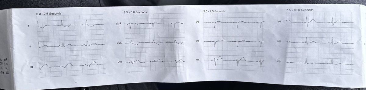 Prehospital Cath Lab Activation. What happened when the medics and patient arrived at this Academic ED?

hqmeded-ecg.blogspot.com/2024/11/prehos…