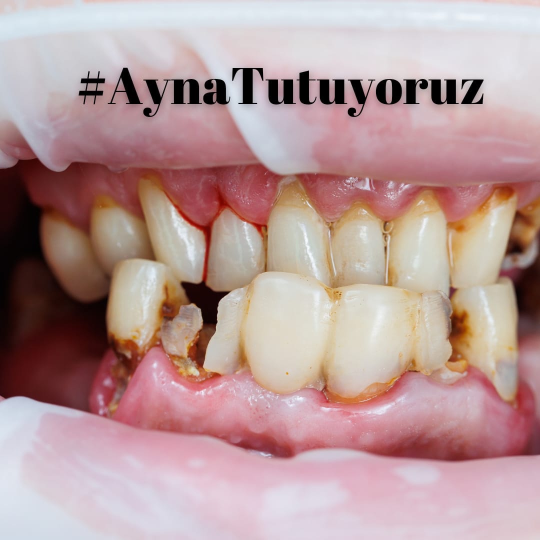 10-15 dakikalık <a href="/MHRS_182/">MHRS</a> randevuda ne yapılabilir?
Yoksul maaşı alan diş hekimi ne yapabilir?
<a href="/saglikbakanligi/">T.C. Sağlık Bakanlığı</a> <a href="/drmemisoglu/">Prof. Dr. Kemal Memişoğlu</a> <a href="/Akparti/">AK Parti</a> <a href="/herkesicinCHP/">CHP 🇹🇷</a> <a href="/TBMMresmi/">TBMM</a>