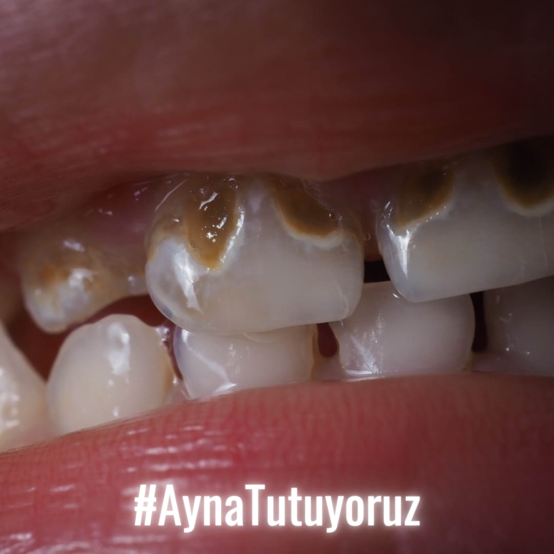 Sarkomer3's tweet photo. 10 dakikalık randevular maalesef hastaların derdine derman olmuyor. Bu da sistemi ve hekimleri yoruyor. Ekonomik olarak da milyonlarca tl maalesef kayıp oluyor. Bunların düzelmesi için ve böylesi ağızların daha en başından önüne geçmek için sisteme ayna tutuyoruz.
#AynaTutuyoruz https://t.co/SNsWmjgJtw