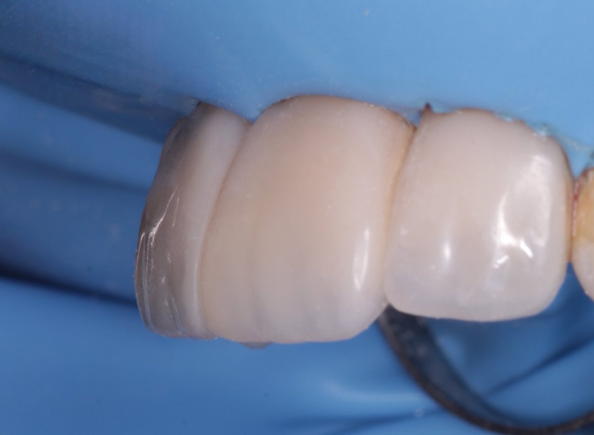 wasayef_h's tweet photo. Direct composite build-up by layering technique 🤍✨ https://t.co/5ltVuR8qJX