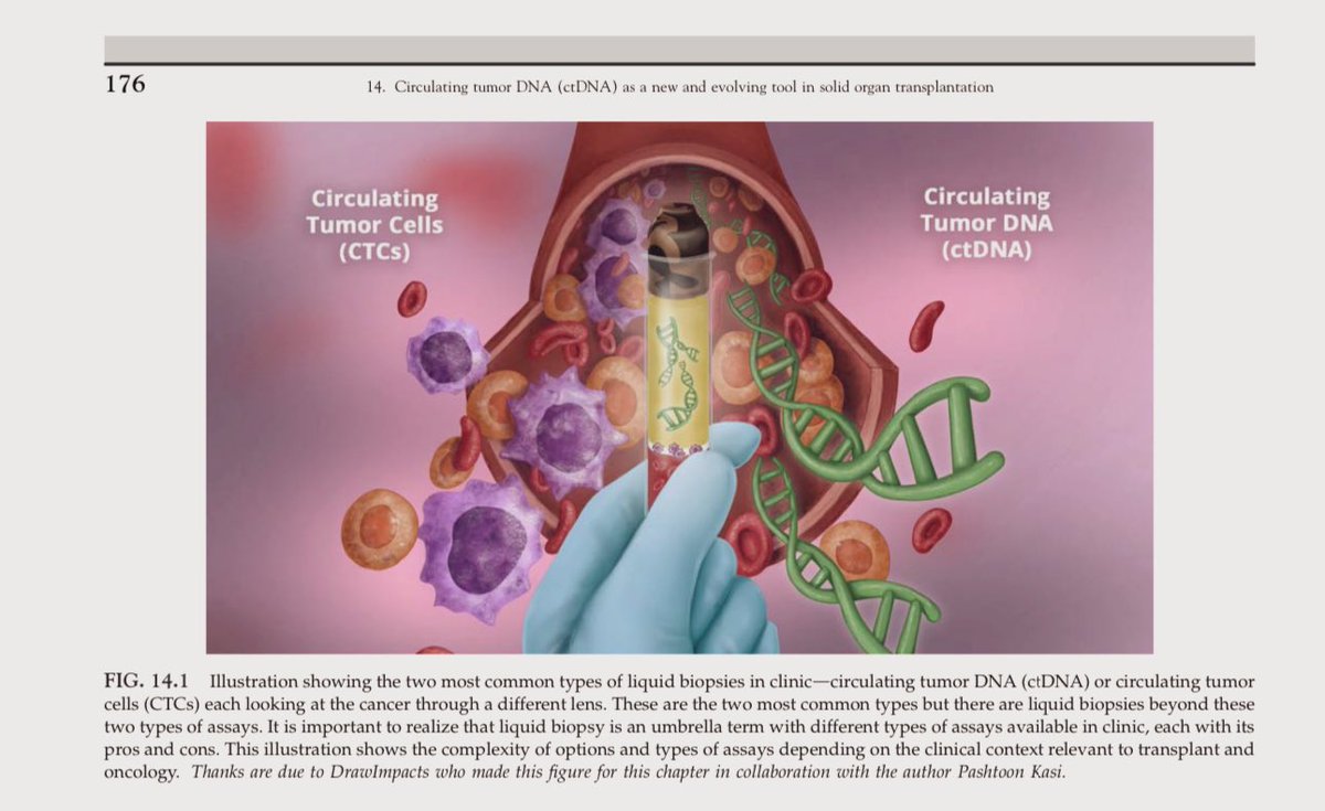 pashtoonkasi's tweet image. Delighted to have contributed to this book📕on Transplant Oncology. 

Edited by: @MaenAbdelrahim
Foreword: @JimAllisonPhD

📝My chapter focuses on #LiquidBiopsies #CTCs, 🟣🟠 #ctDNA🩸🧬and beyond💡.

Out now➡️Amazon/Elsevier. 
📌a.co/d/bOQu50R

@OncoAlert @DrawImpacts