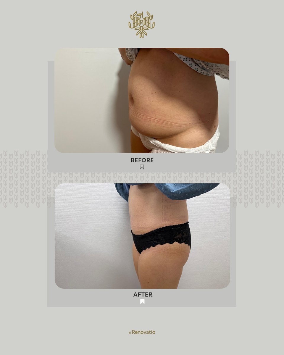 Just 6 weeks post-tummy tuck, and the transformation is incredible! ✨
Our patient is healing beautifully, with a flatter, more contoured abdomen and renewed confidence. It’s amazing to see such results so soon after surgery.