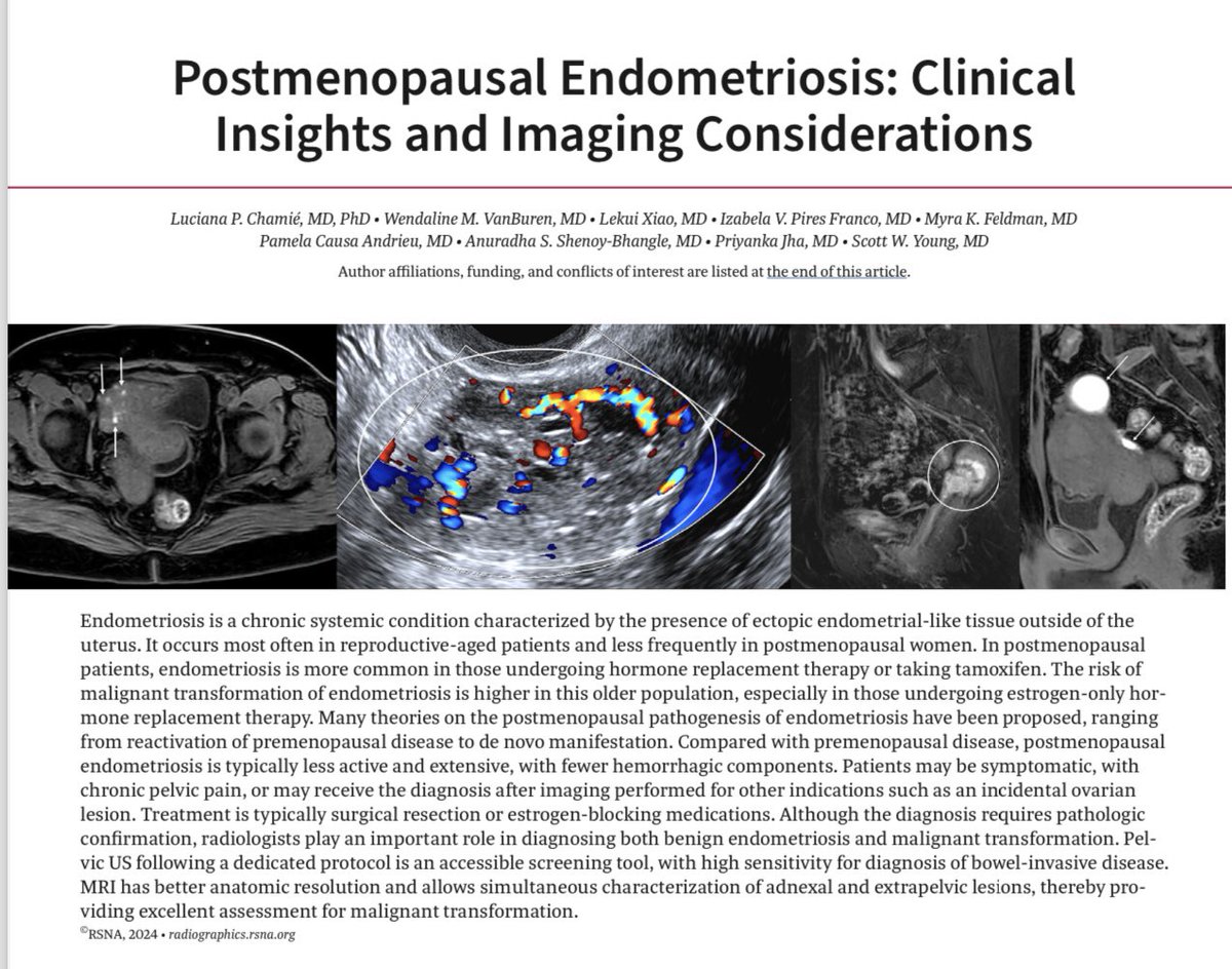 luciana@chamie.com.br (@lucianachamiec1) on Twitter photo We are pleased to share our latest article, which explores the clinical and imaging characteristics of endometriosis in postmenopausal women.
@wendalinevb @myrafeldmanmd @lp_pam_ @lekraykray @clinicaizabelapiresfranco @ASBEpic <a href="/PriyankaJhaMD/">Priyanka Jha</a> @scottwyoung @rsnagram @cookyscan We are pleased to share our latest article, which explores the clinical and imaging characteristics of endometriosis in postmenopausal women.
@wendalinevb @myrafeldmanmd @lp_pam_ @lekraykray @clinicaizabelapiresfranco @ASBEpic <a href="/PriyankaJhaMD/">Priyanka Jha</a> @scottwyoung @rsnagram @cookyscan
