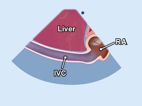 NephroP's tweet photo. #POCUS illustration of the day:
IVC views
- Traditional subxiphoid long axis
- Subxiphoid bicaval view showing SVC in addition
- Subxiphoid transverse view showing IVC and aorta
- Lateral right upper quadrant view showing IVC and aorta
#FOAMed #Nephpearls  #FOAMcc  

Image courtesy - TechMed/ASE guidelines