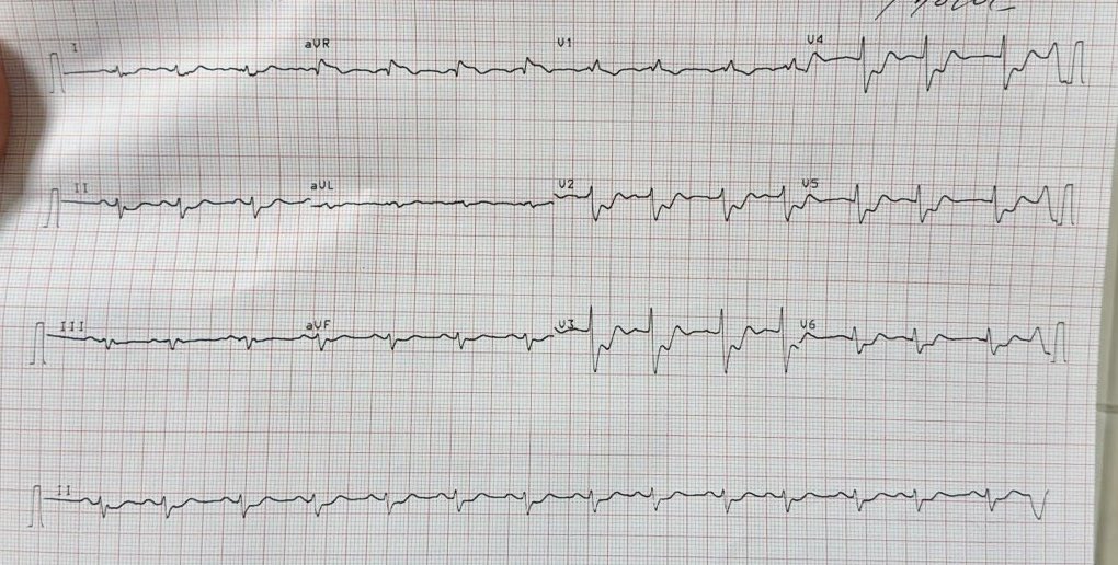 gonzaeperez's tweet image. CASO CLÍNICO INTERESANTE 
Cómo se ve el #ECGfirst y #CCG en la lesión crítica de TCI y CD100%?🤔

81 años, ecoestres con arritmia ventricular y dilatación VI

#ECGfirst #ClinicaOlivos