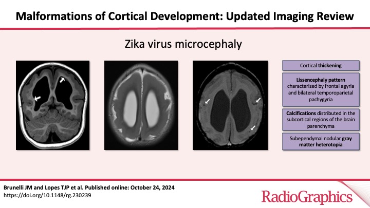 RadioGraphics_Editor (@radg_editor) on Twitter photo Malformations of Cortical Development: Updated Imaging Review
Brunelli JM and Lopes TJP et al.
Neuroradiology
doi.org/10.1148/rg.230…
<a href="/juliabrunelli_/">julia brunelli</a>
<a href="/isabeladsalves/">Isabela Alves, MD</a>
#RGphx
10/12 Malformations of Cortical Development: Updated Imaging Review
Brunelli JM and Lopes TJP et al.
Neuroradiology
doi.org/10.1148/rg.230…
<a href="/juliabrunelli_/">julia brunelli</a>
<a href="/isabeladsalves/">Isabela Alves, MD</a>
#RGphx
10/12