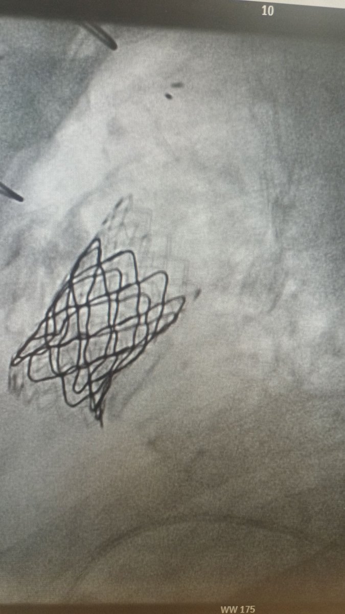 AlkashkariWail's tweet photo. It was so difficult to advance the 14Fr Mullin sheath through the pre-dilated 22 Contegra conduit (with 20mm Z-med 🎈) to do pre-stenting with BeGraft Aortic Bentley covered stent to implant #Melody valve 22mm. We used the BAT (Balloon assisted tracking) with #Armada🎈8×80mm to advance the sheath and to fix the sheath while unfolding the loop. It worked like a charm. I love ❤️it.
@mirvatalasnag @structuralheart @cliff @nkc01499 @AARiyadh @mhammadah @RHammami_cardio @amrabbasmd @MamdouhIsmail1 @Almanfi_Cardio @fjsawaya @Medtronic @AbbottNews