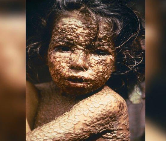 This is what smallpox looks like. RFK Jr. wants to eliminate the smallpox vaccine. Good luck everyone. This is what you voted for.