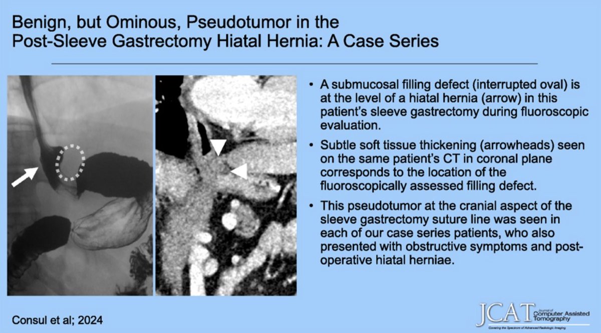 Monica Cheng, MD (@monicacheng_) on Twitter photo 📜 In <a href="/JCATonline/">JCAT Online</a> with <a href="/nikitaconsul/">Nikita Consul, MD</a> & Dr. Francis Scholz <a href="/MGHImaging/">Mass General Imaging</a>, we examine the ominous but benign phenomenon of pseudotumor in patients with post-sleeve gastrectomy hiatal hernias—important to recognize in the postop #bariatric surgical setting.
🔗 journals.lww.com/jcat/abstract/… 📜 In <a href="/JCATonline/">JCAT Online</a> with <a href="/nikitaconsul/">Nikita Consul, MD</a> & Dr. Francis Scholz <a href="/MGHImaging/">Mass General Imaging</a>, we examine the ominous but benign phenomenon of pseudotumor in patients with post-sleeve gastrectomy hiatal hernias—important to recognize in the postop #bariatric surgical setting.
🔗 journals.lww.com/jcat/abstract/…
