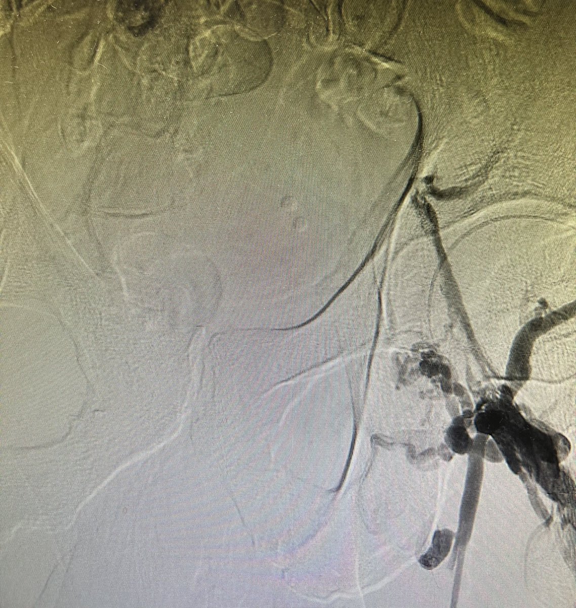 LeonardoRandial's tweet photo. 40 y/o man with severe post thrombotic synd.  Went classic Palma Procedure @docpark @limbsalvagedr @DevinZarkowsky @gloviczki @GustavoOderich @GAEscobarMD @jmills1955 https://t.co/HIuvJIgxVL
