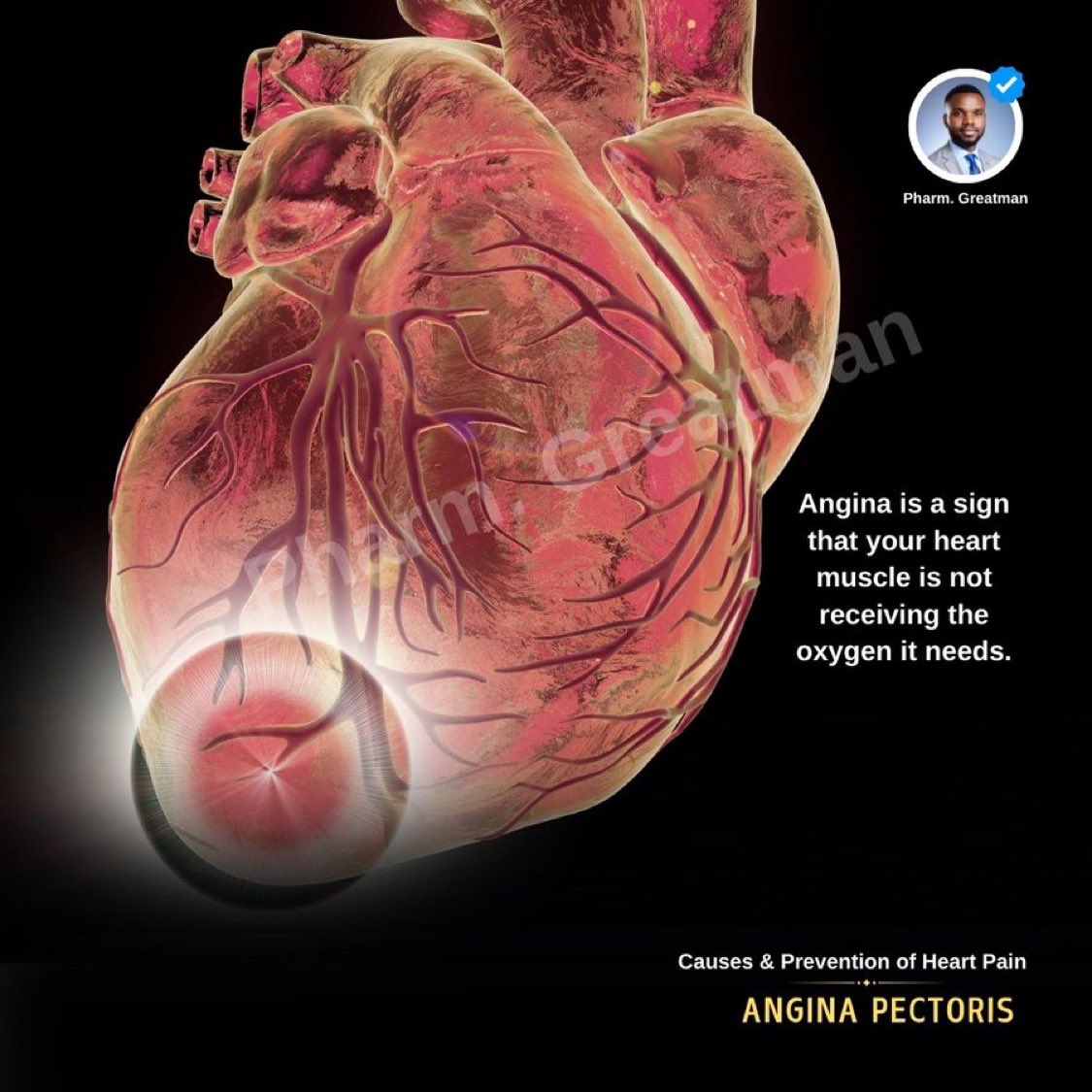 Are you feeling tightness or pressure in your chest during exercise or ...