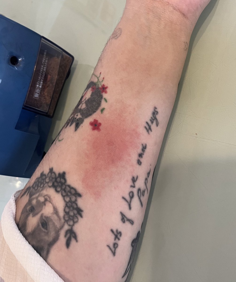 How the mosquito bite started—> how it looks now (I’m allergic to Japanese mosquitos???)