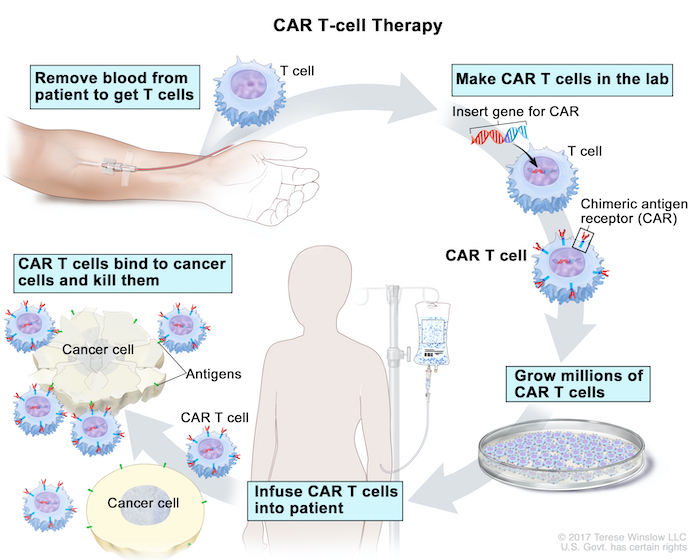 jyves94's tweet photo. Une grande victoire pour les #CAR_Tcells ✂️ !
Est paru le 14 novembre 2024 au journal officiel l'arrêté qui fait entrer le #CAR_T #Abecma dans le droit commun.
Il est désormais remboursé par la sécurité sociale comme tout médicament qui a fait ses preuves.
Il a fallu 3 années pour que l'accès à ce traitement innovant sorte de dispositifs de dérogatoires et soit enfin garanti.
Aujourd'hui 30 centres hospitaliers répartis sur tout le territoire sont habilités à le proposer aux malades et il n'y a plus de limites de quantité liées à la fabrication.
Un immense merci aux hématologues, aux équipes soignantes et bien sûr aux malades qui ont démontré par les essais cliniques par le dispositif d'accès précoce que les CAR_T apportaient était un immense progrès dans le traitement du #MyélomeMultiple.
Merci au laboratoire qui a continué à nous fournir le traitement malgré les "difficultés administratives" et qui n'est pas allé se réfugier dans un pays où la législation lui aurait été plus favorable.
Arrêté du 14 novembre 2024 limitant l'utilisation de médicaments de thérapie innovante à base de lymphocytes T génétiquement modifiés dits CAR-T Cells autologues à certains établissements de santé en application des dispositions de l'article L. 1151-1 du code de la santé publique.
Fait à Paris le 28 juin 2024.
La ministre du travail, de la santé et des solidarités,
Pour la ministre et par délégation :
La directrice générale de l'offre de soins,
M. Daudé
Le ministre de l'économie, des finances et de la souveraineté industrielle et numérique,
Pour le ministre et par délégation :
Le directeur de la sécurité sociale,
P. Pribile
https://t.co/gECChDSSrx