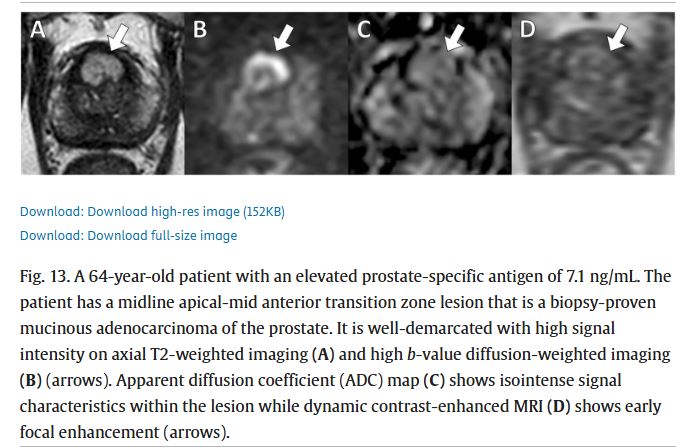 Baris Turkbey MD (@radiolobt) on Twitter photo 📣#3
I am happy to share our new review article "Interpreting Prostate Multiparametric MRI: Beyond Adenocarcinoma – Anatomical Variations, Mimickers, and Post-Intervention Changes"
sciencedirect.com/science/articl…
👏👍Big congratulations to <a href="/eniscy/">Enis C. Yilmaz, MD</a> <a href="/OTEsengur/">Ömer Tarık Esengür, MD</a> <a href="/davidgelikman/">David Gelikman, MD</a> for this 📣#3
I am happy to share our new review article "Interpreting Prostate Multiparametric MRI: Beyond Adenocarcinoma – Anatomical Variations, Mimickers, and Post-Intervention Changes"
sciencedirect.com/science/articl…
👏👍Big congratulations to <a href="/eniscy/">Enis C. Yilmaz, MD</a> <a href="/OTEsengur/">Ömer Tarık Esengür, MD</a> <a href="/davidgelikman/">David Gelikman, MD</a> for this