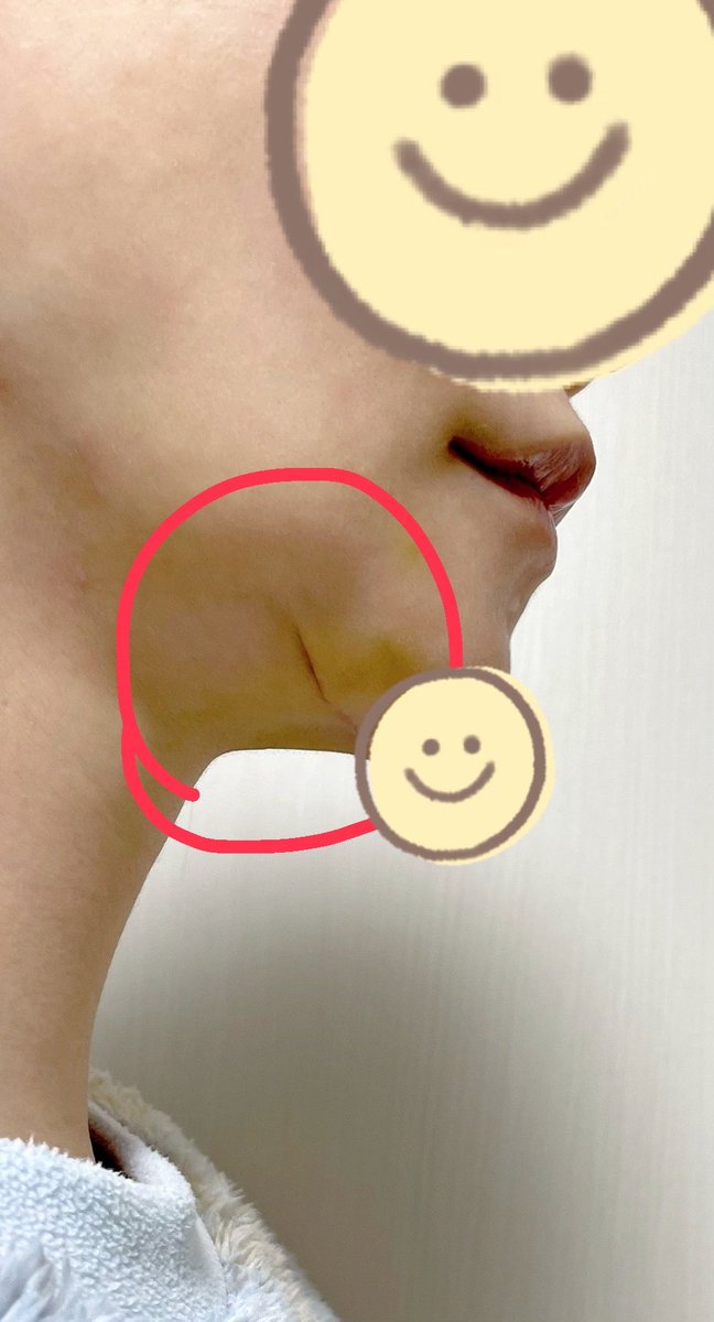 natade_coco29's tweet photo. これ載せるだけで法的措置取られるの？
なぁぜなぁぜ ？？？
自分がやったってバラされたくないから？
てことは、暗に失敗だと認めてますよね？
反論あります？？？（青タンはオトガイプレ除去時のもので、この汚い縫合とは一切関係ありません！） https://t.co/yxKae9JHCz