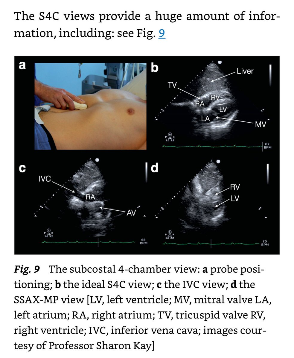 POCUSpeek's tweet image. 1. #firstecho basic views with annotations from 🔗doi.org/10.1007/978-3-… ← excellent #POCUS resource #heart