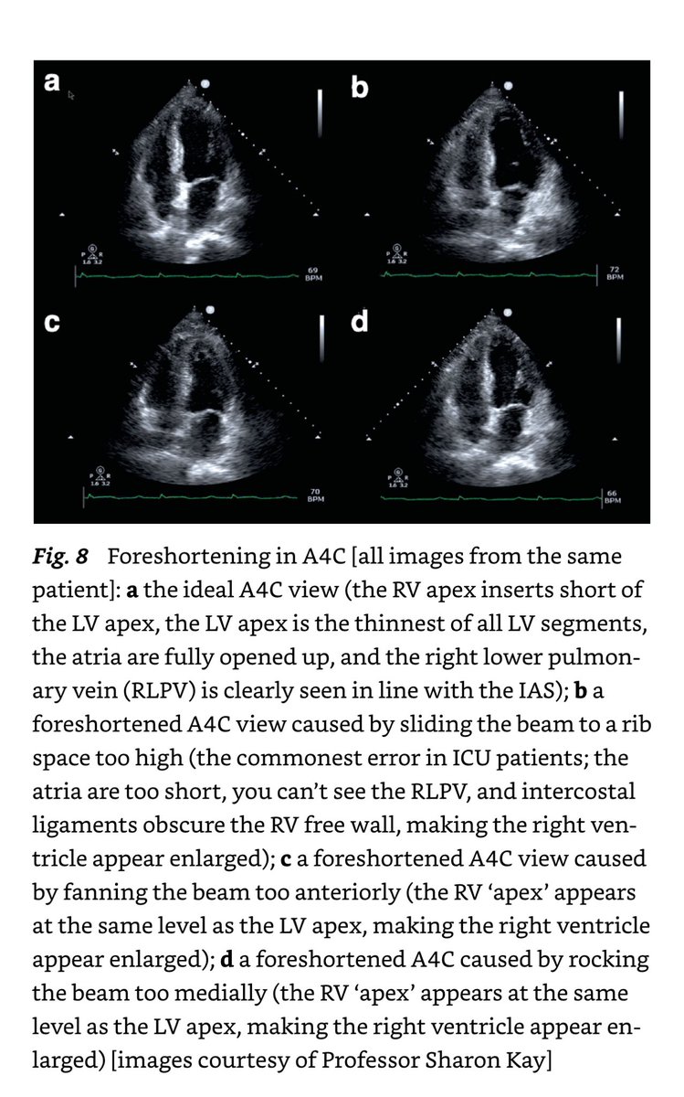 POCUSpeek's tweet image. 1 Foreshortening and correction ← my nightmare #firstecho from 🔗doi.org/10.1007/978-3-…