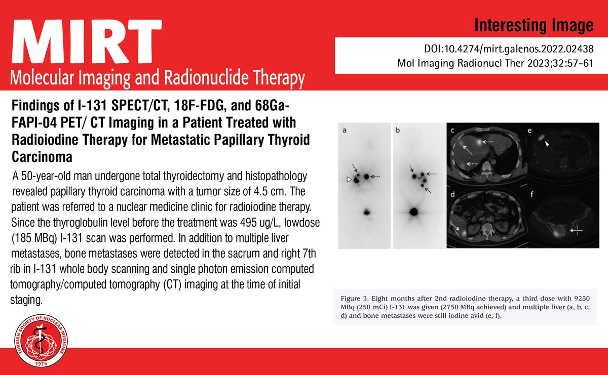 's tweet image. Findings of I-131 SPECT/CT, 18F-FDG, and 68Ga-FAPI-04 PET/ CT Imaging in a Patient Treated with Radioiodine Therapy for Metastatic Papillary Thyroid Carcinoma

You can see the free full text of the research by Gamze Tatar et al.

Link : mirt.tsnmjournals.org/articles/findi…