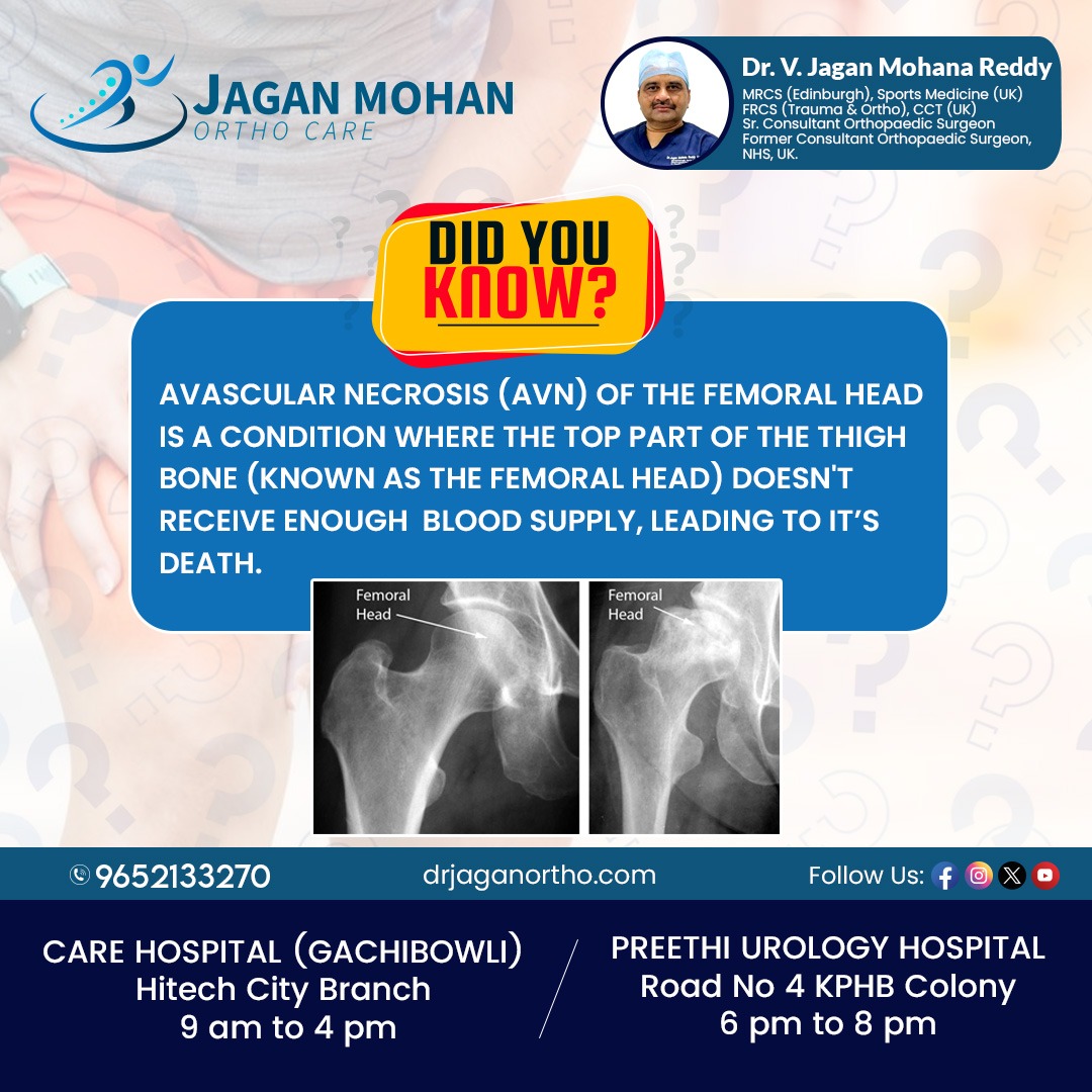 JaganOrthopedic's tweet image. Avascular necrosis (AVN) is a condition where blood flow to bones is reduced, leading to bone tissue death. 

Book your appointment now
Call: 9652133270
#drjaganortho #hitechcity #kphp #AvascularNecrosis #BoneHealth #JointPain

visit
drjaganortho.com