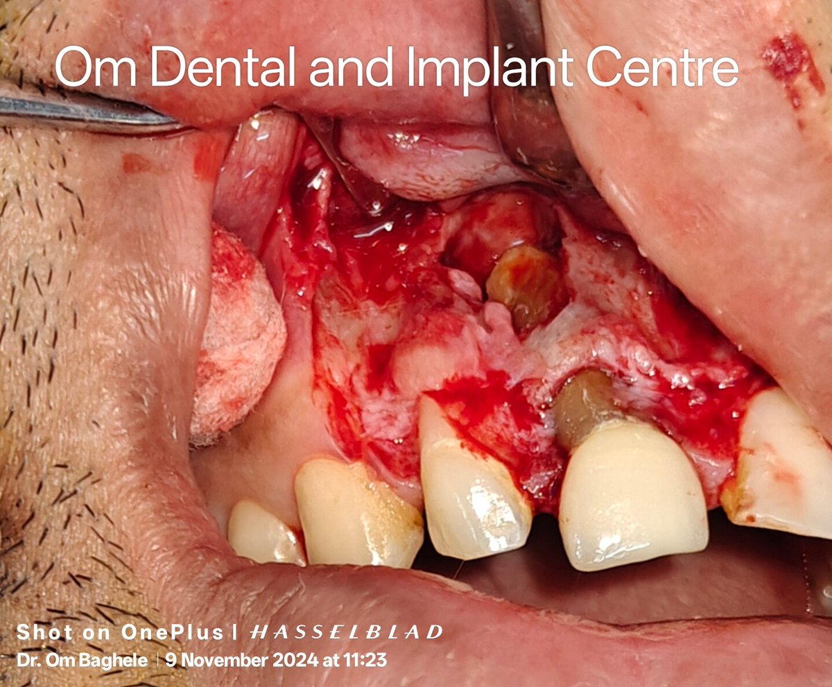 ombaghele's tweet photo. Periapical Surgery 
In few cases, even after doing..For more info visit...https://t.co/G0QN48FINd https://t.co/dJ12s69Elz