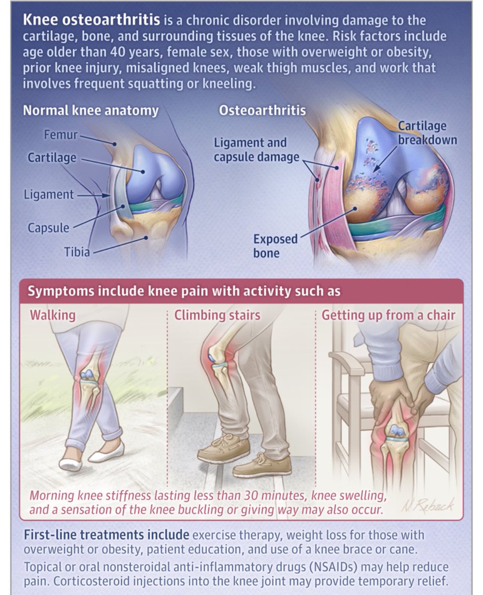 What Is Knee Osteoarthritis?